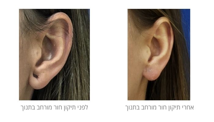 לפני ואחרי תיקון תנוך האוזן
