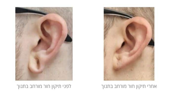 לפני ואחרי תיקון תנוך האוזן