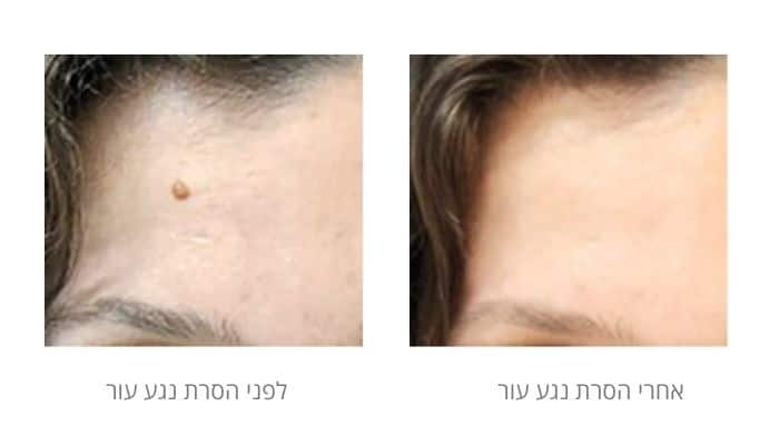 לפני ואחרי הסרת נגעים בעור